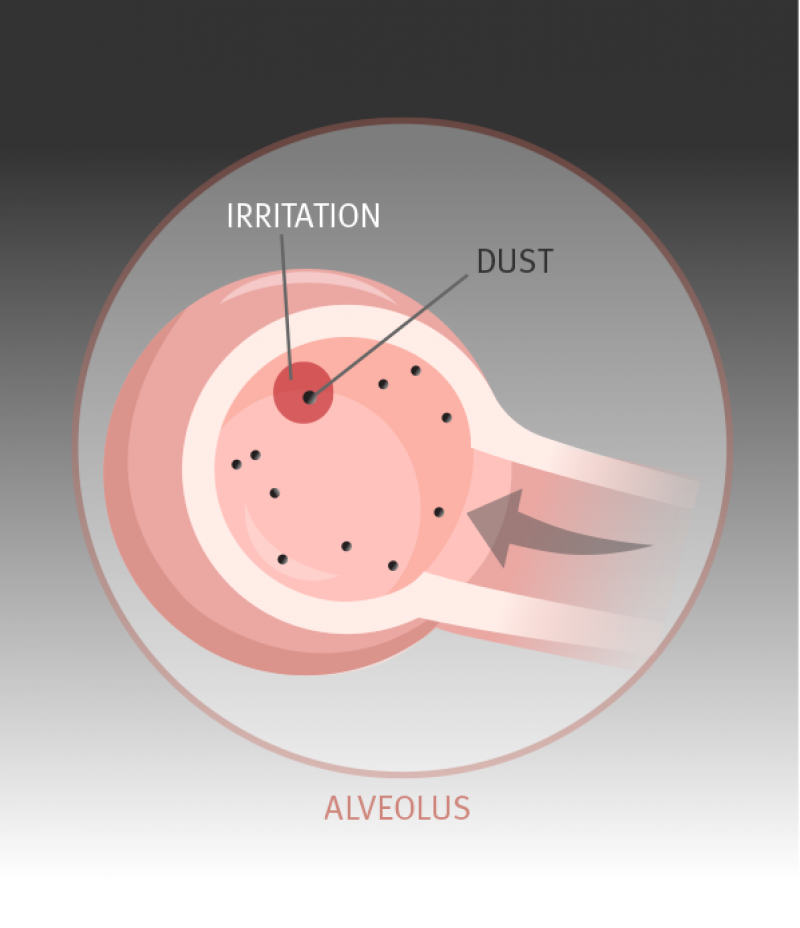 In response to the dust particles, the lung’s defence mechanism kicks in. Macrophages, a type of white blood cell, engulf the dust particles to destroy or clear them away.
