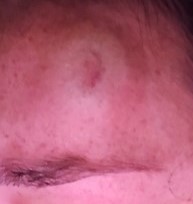 a person's face showing an injury on forehead
