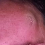 partial view of a person's face showing a large lump on their forehead