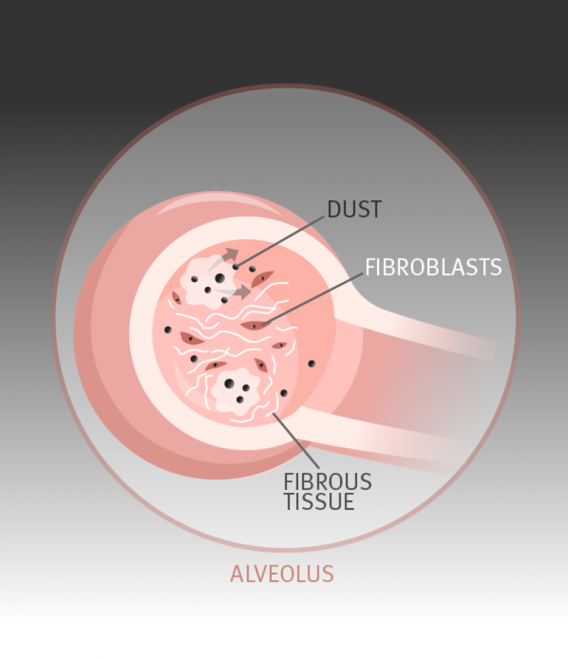 If the concentration of dust is too high, a wider immune response is triggered by the macrophages. Fibroblast cells produce collagen to form nodules of scar tissue around the particles in an attempt to trap the coal-laden macrophages.