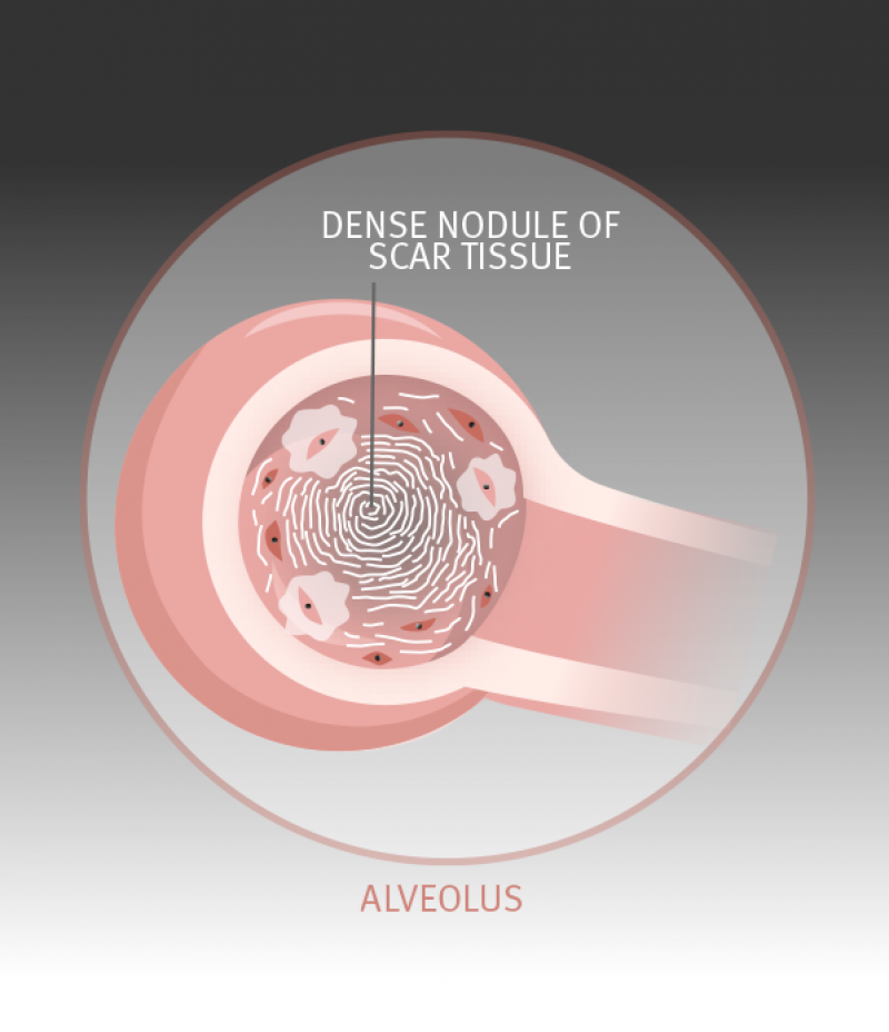 Over time, with continued overexposure to respirable dust, the process repeats many times and more nodules of scar tissue form.