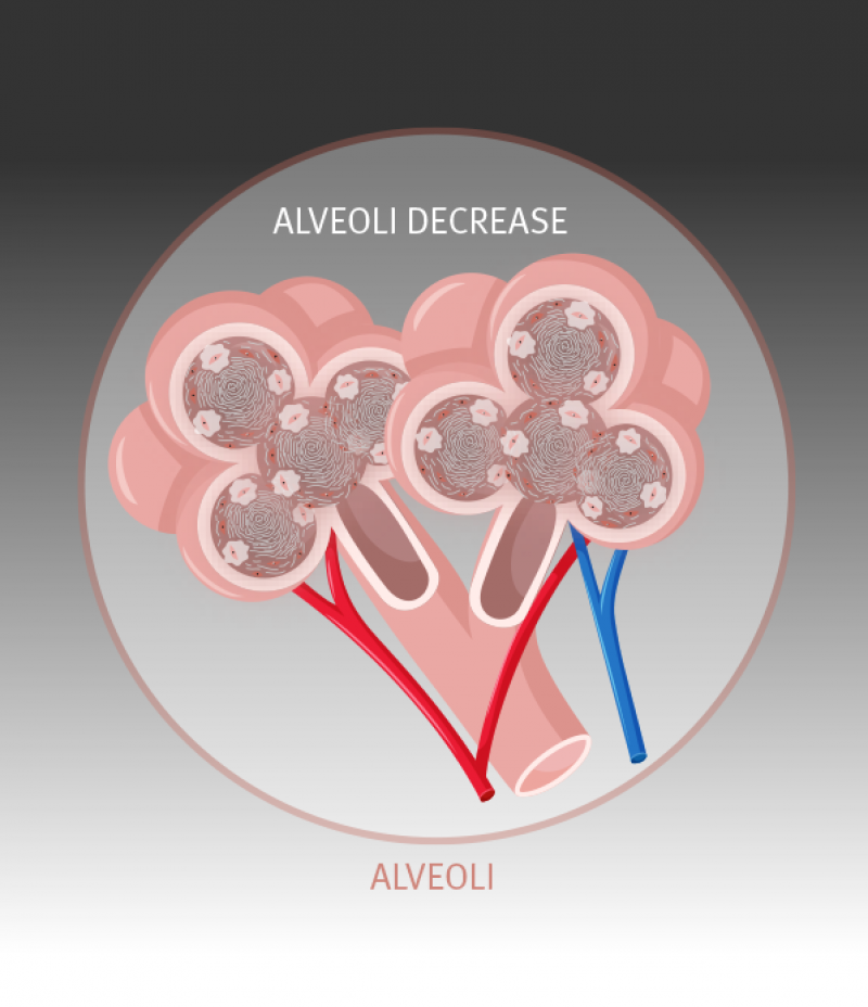 Overcome with scar tissue, the alveoli become unable to function normally, reducing the transfer of oxygen into the bloodstream.