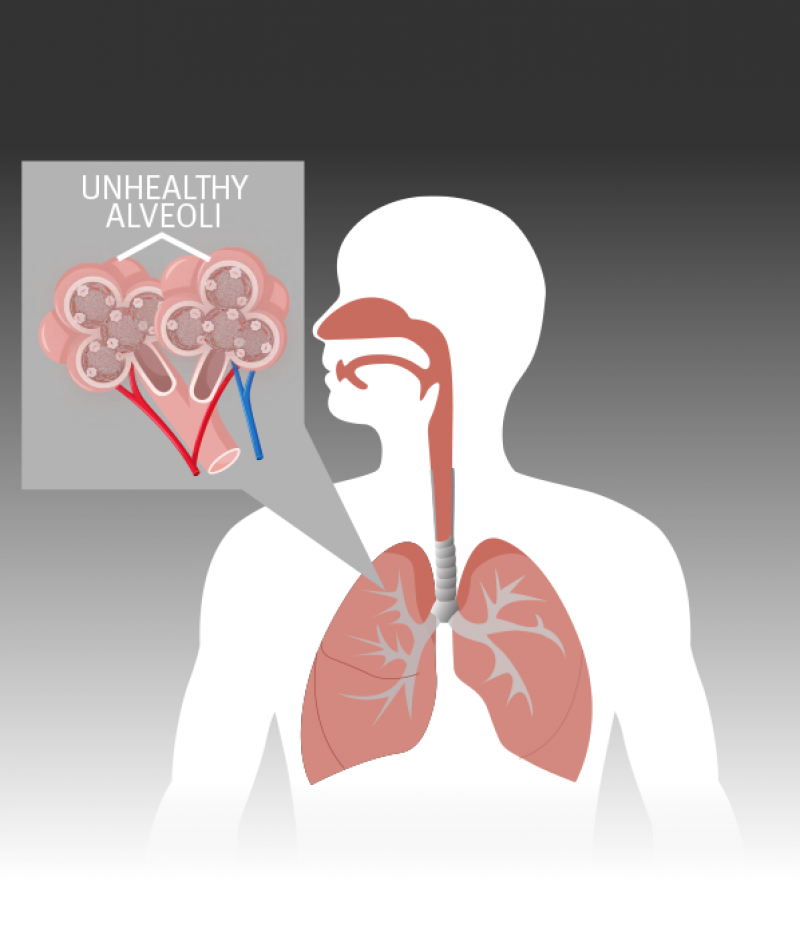 An illustration showing person's lungs and a depiction of what unhealthy alveoli inside the lungs looks like